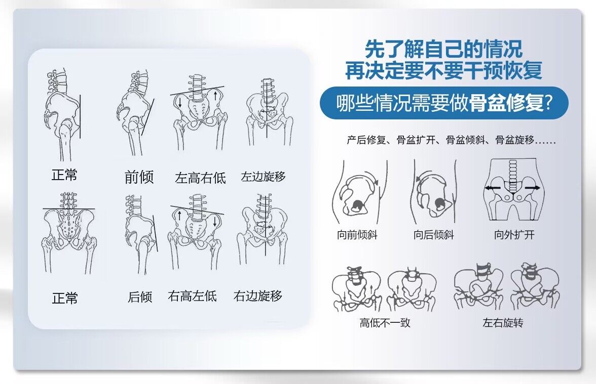 成都产后修复_骨盆体态调整骨盆倾斜旋转移位示意图