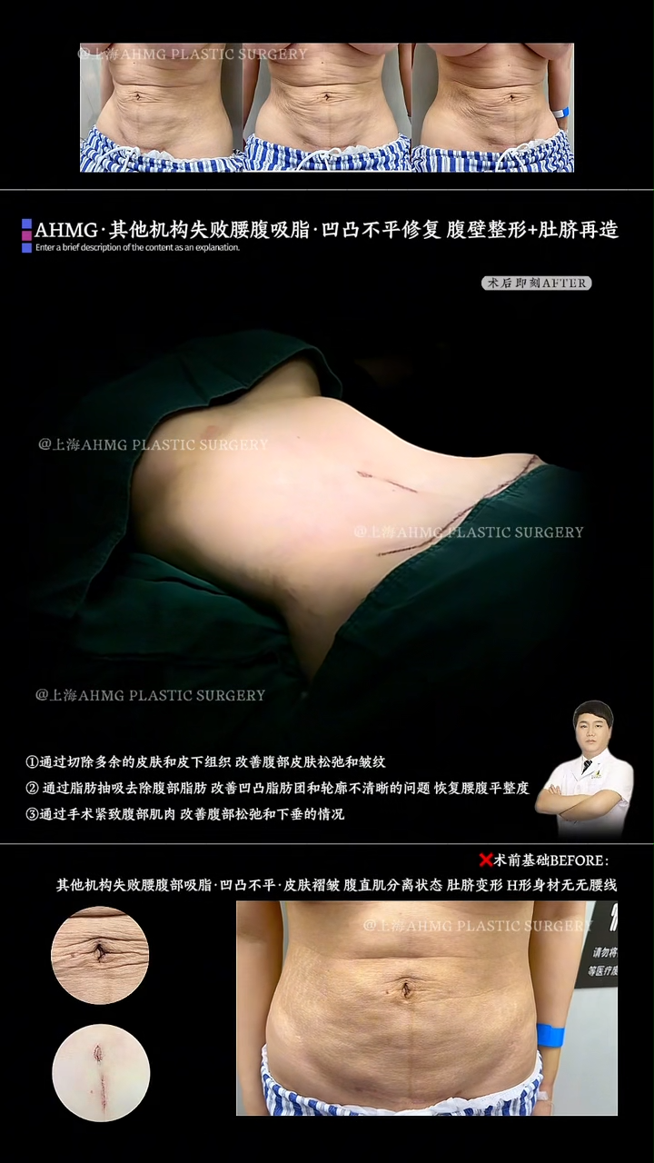 Abdominoplasty with Umbilicoplasty for Correction of Irregularities Following Failed Liposuction at Other Facilities