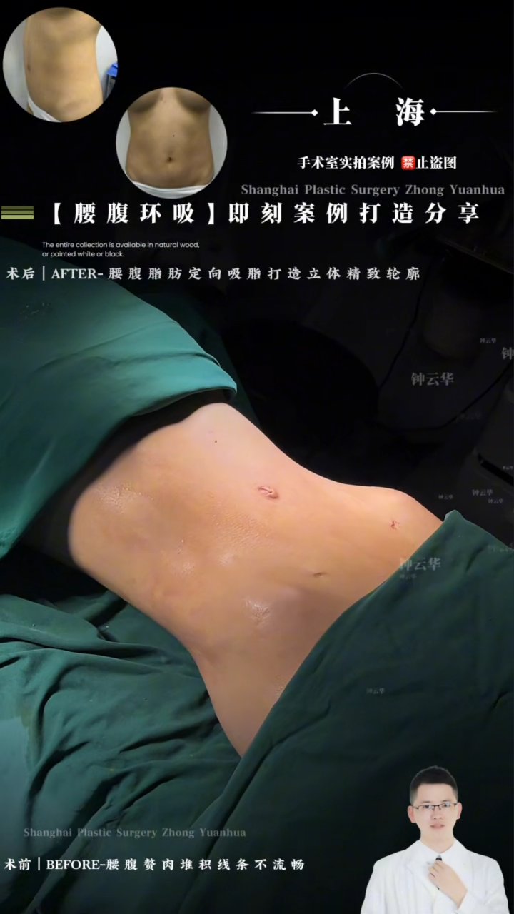 Targeted liposuction of the abdomen and waist to sculpt a defined, refined contour.