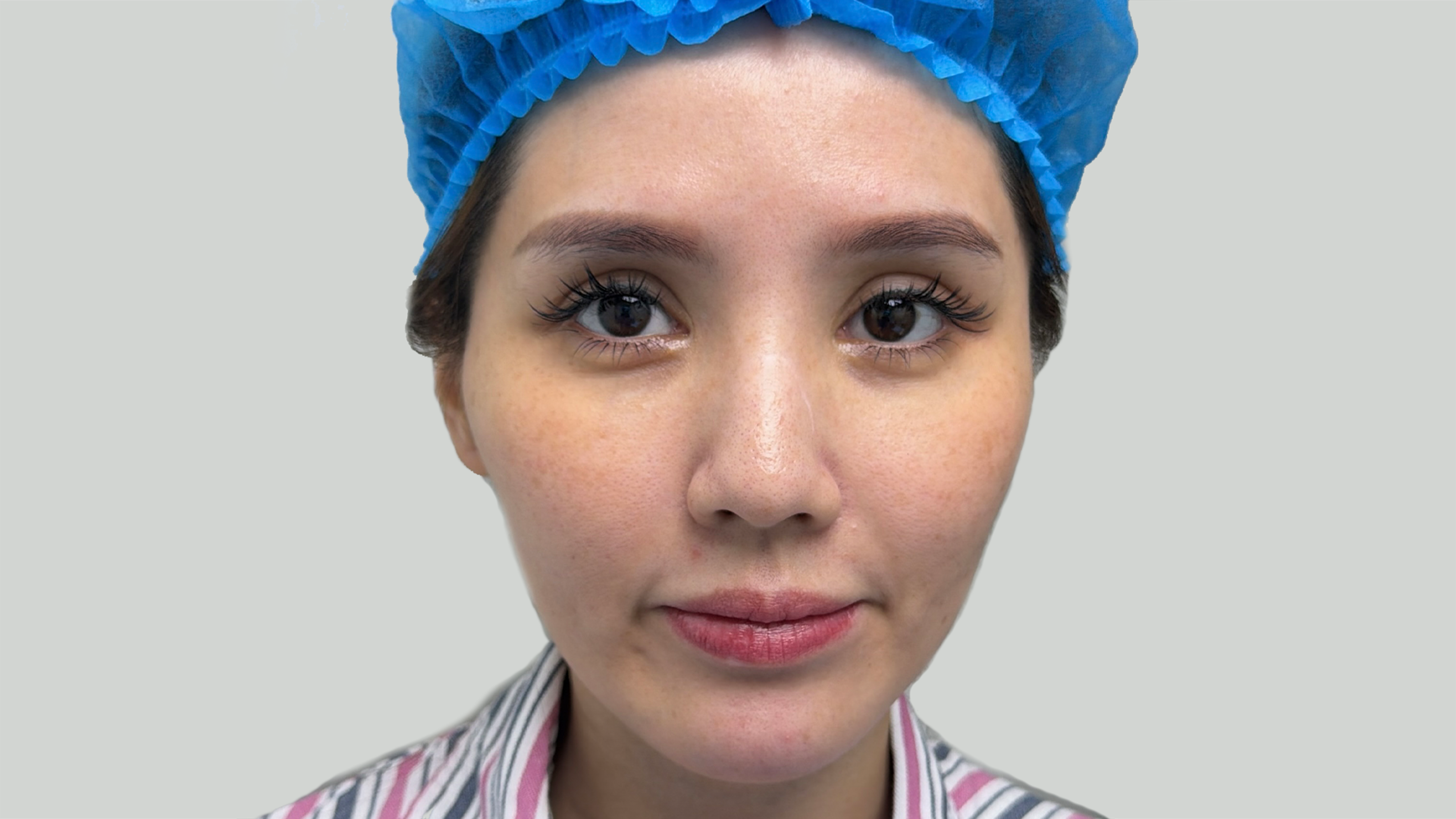 Jawline Lift - Pre-op