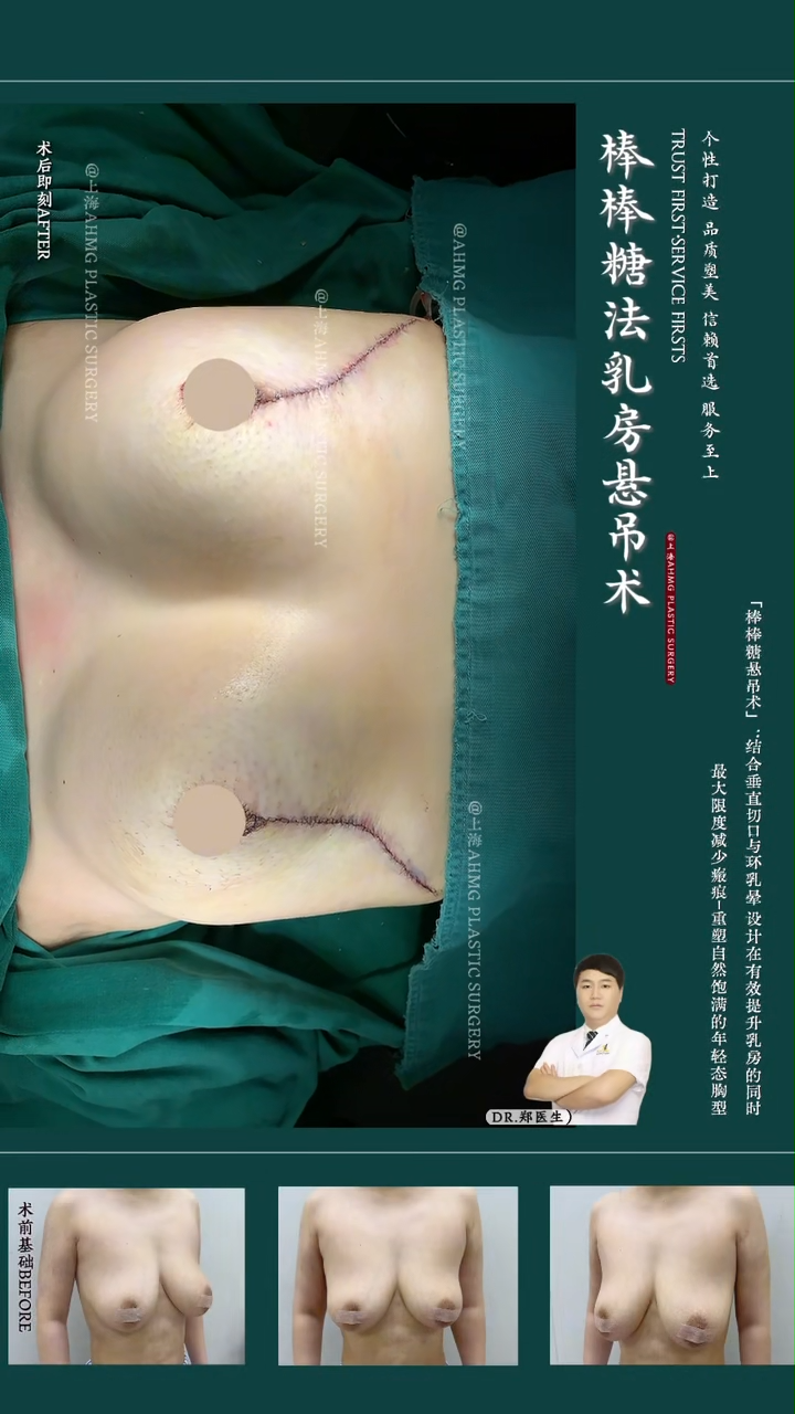 Lollipop breast lift