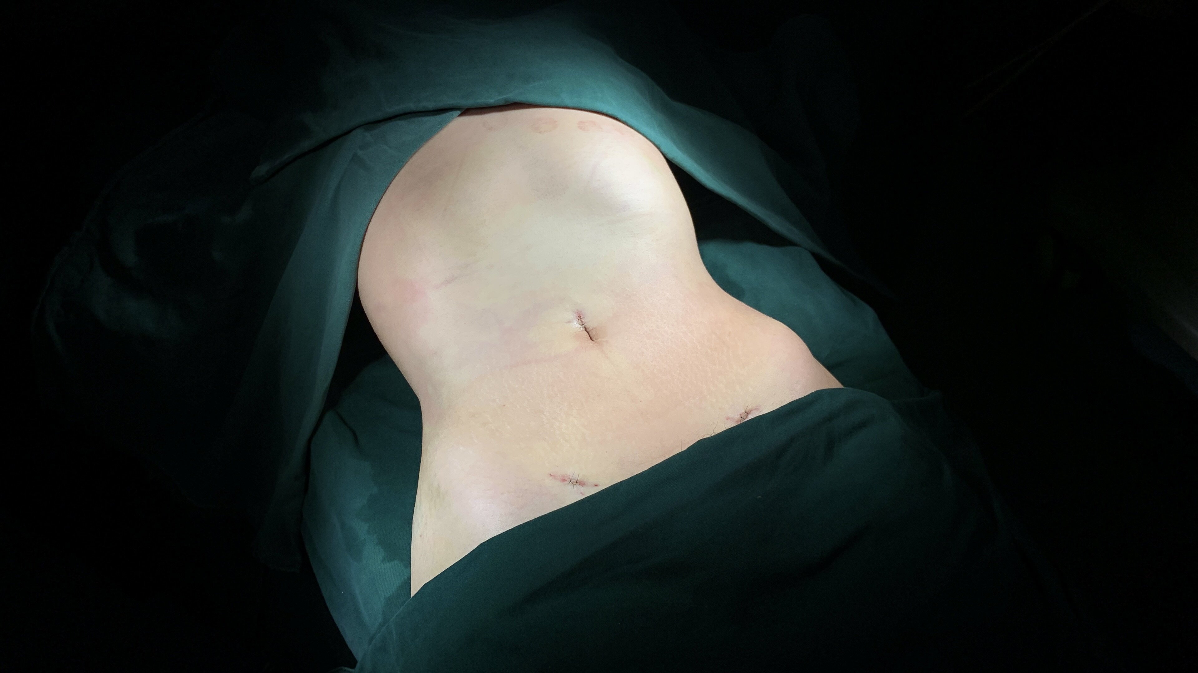 Full-body Liposuction and Contouring