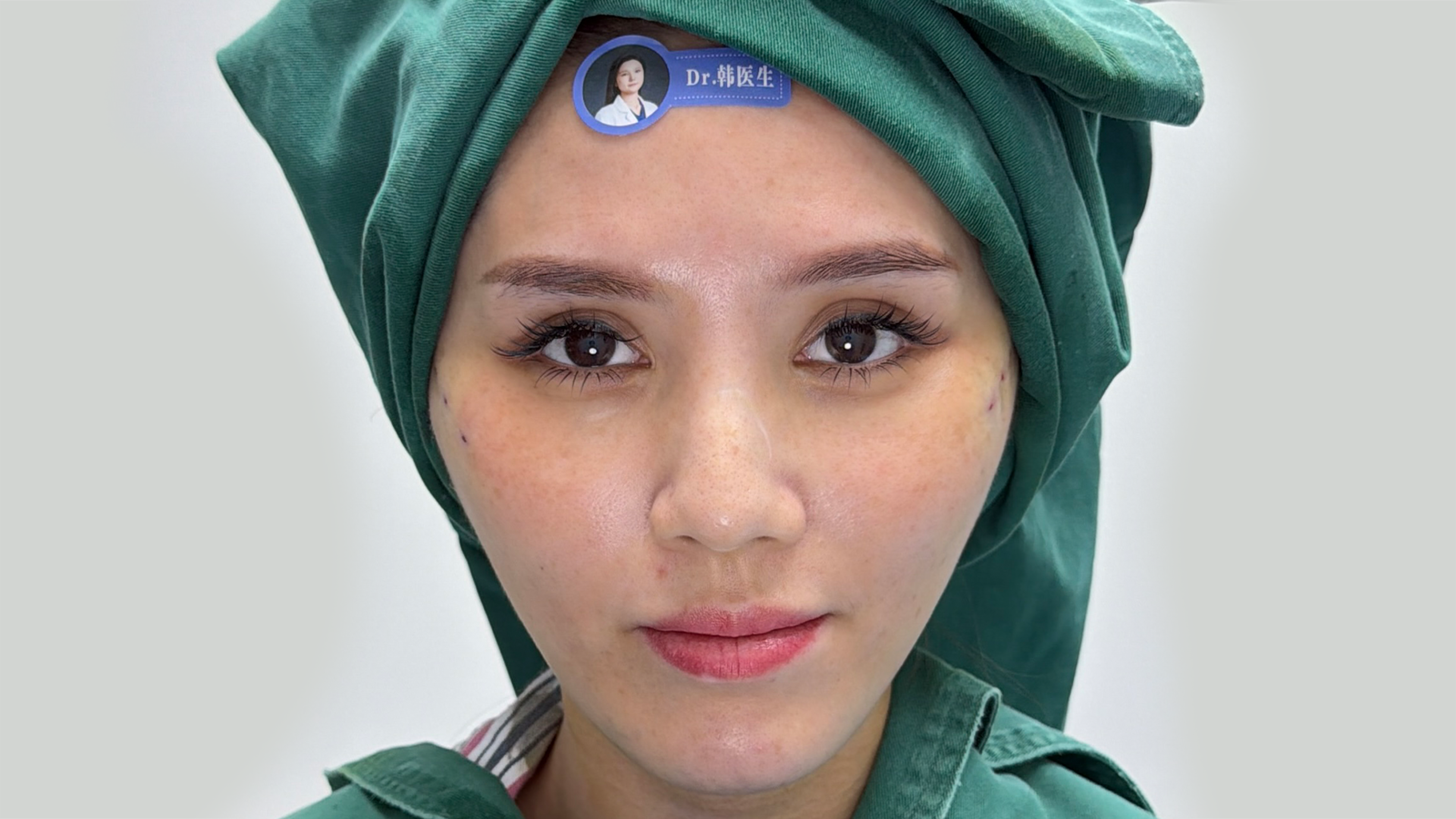 Jawline Lift - Post-Op