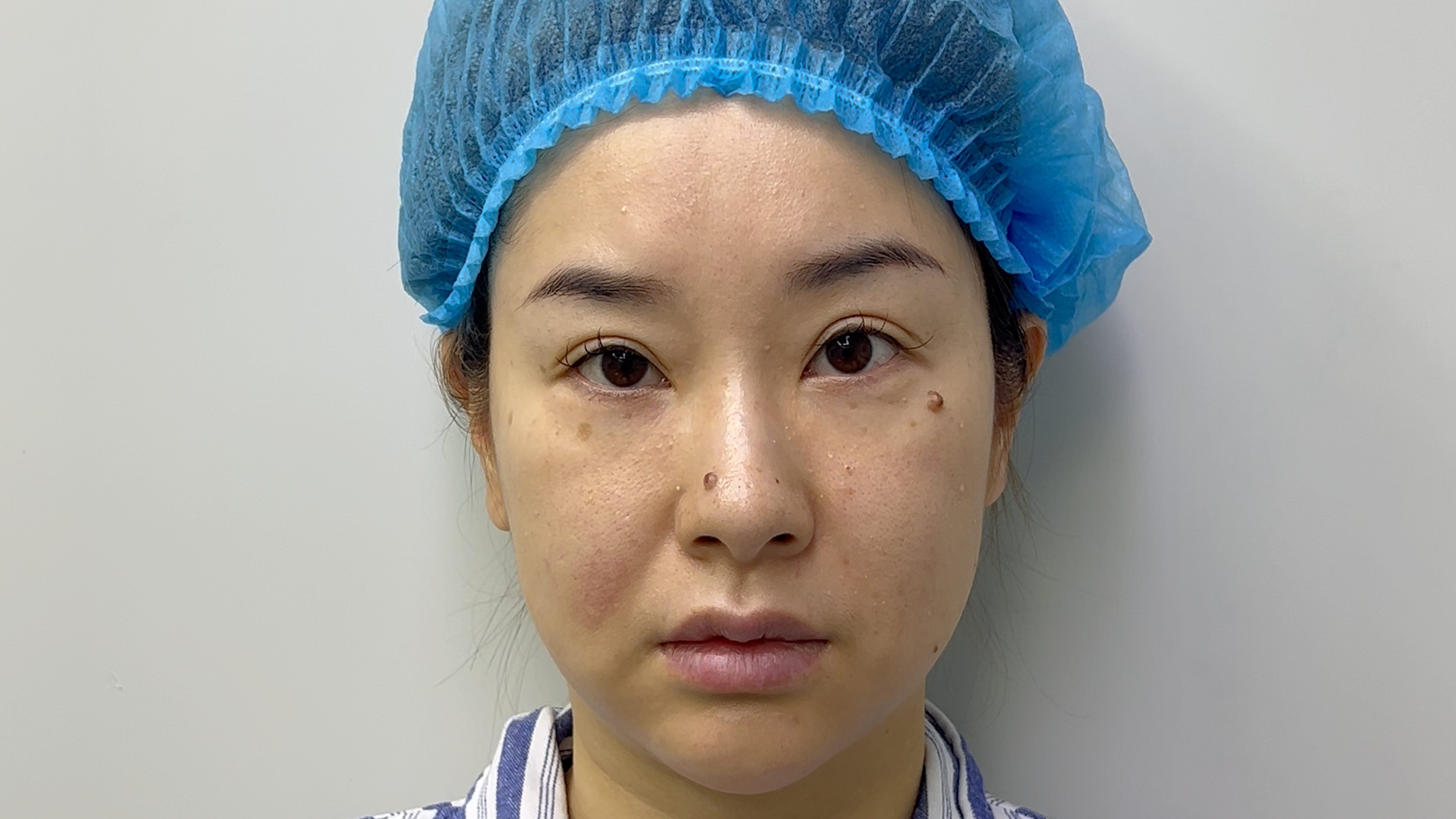 Perioral Marionette Lines Improvement – Pre-treatment