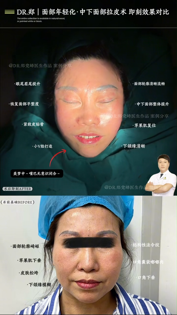 Facial Rejuvenation: Mid and Lower Face Lift
