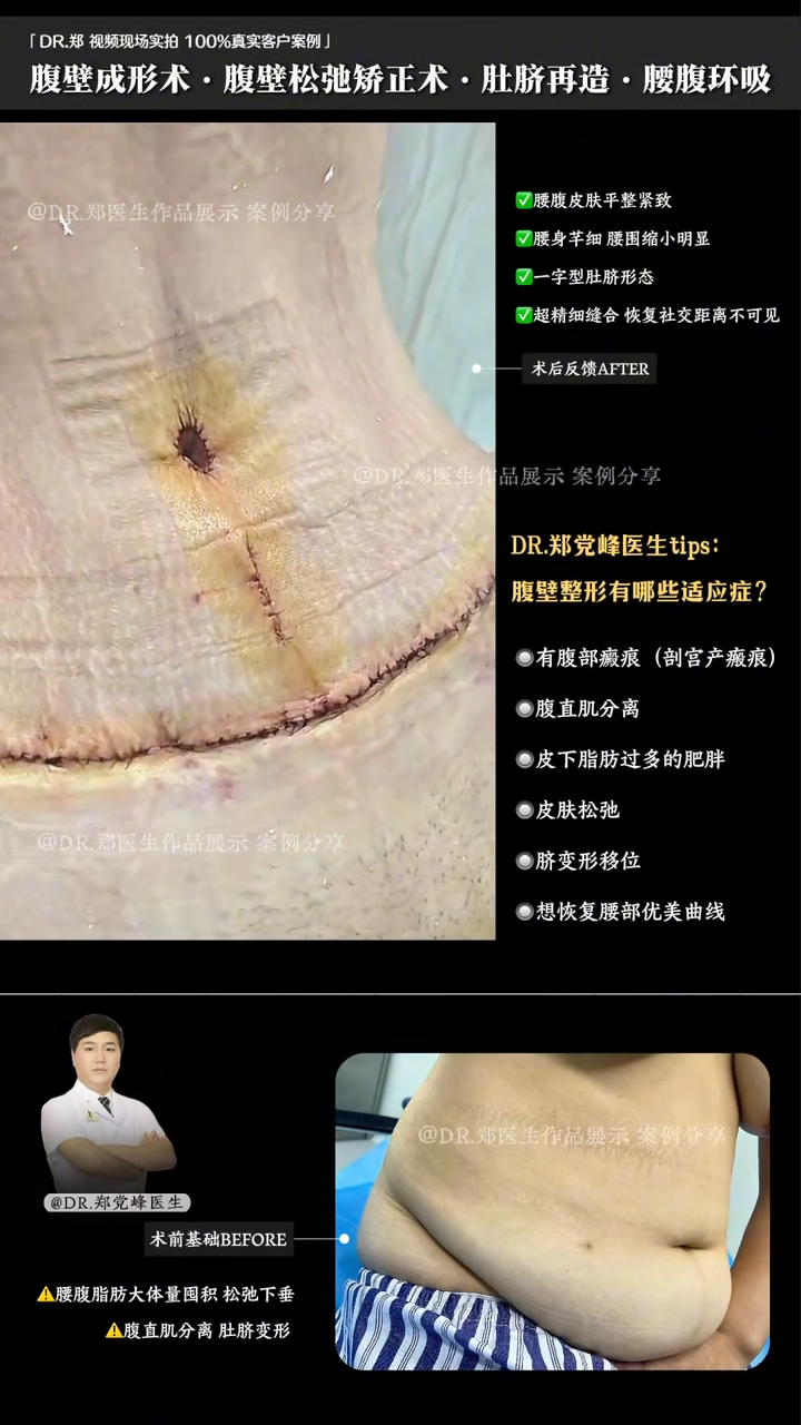 Abdominoplasty · Abdominal Wall Relaxation Correction · Umbilicus Reconstruction · Liposuction of Waist and Abdomen