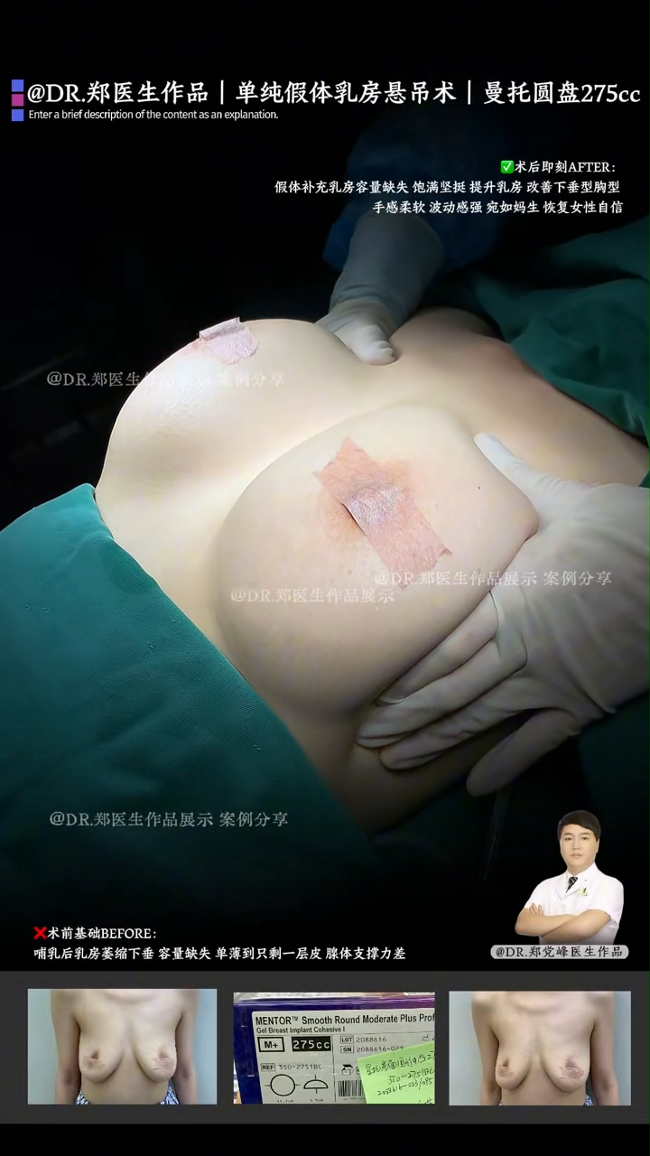 Simple implant-based mastopexy