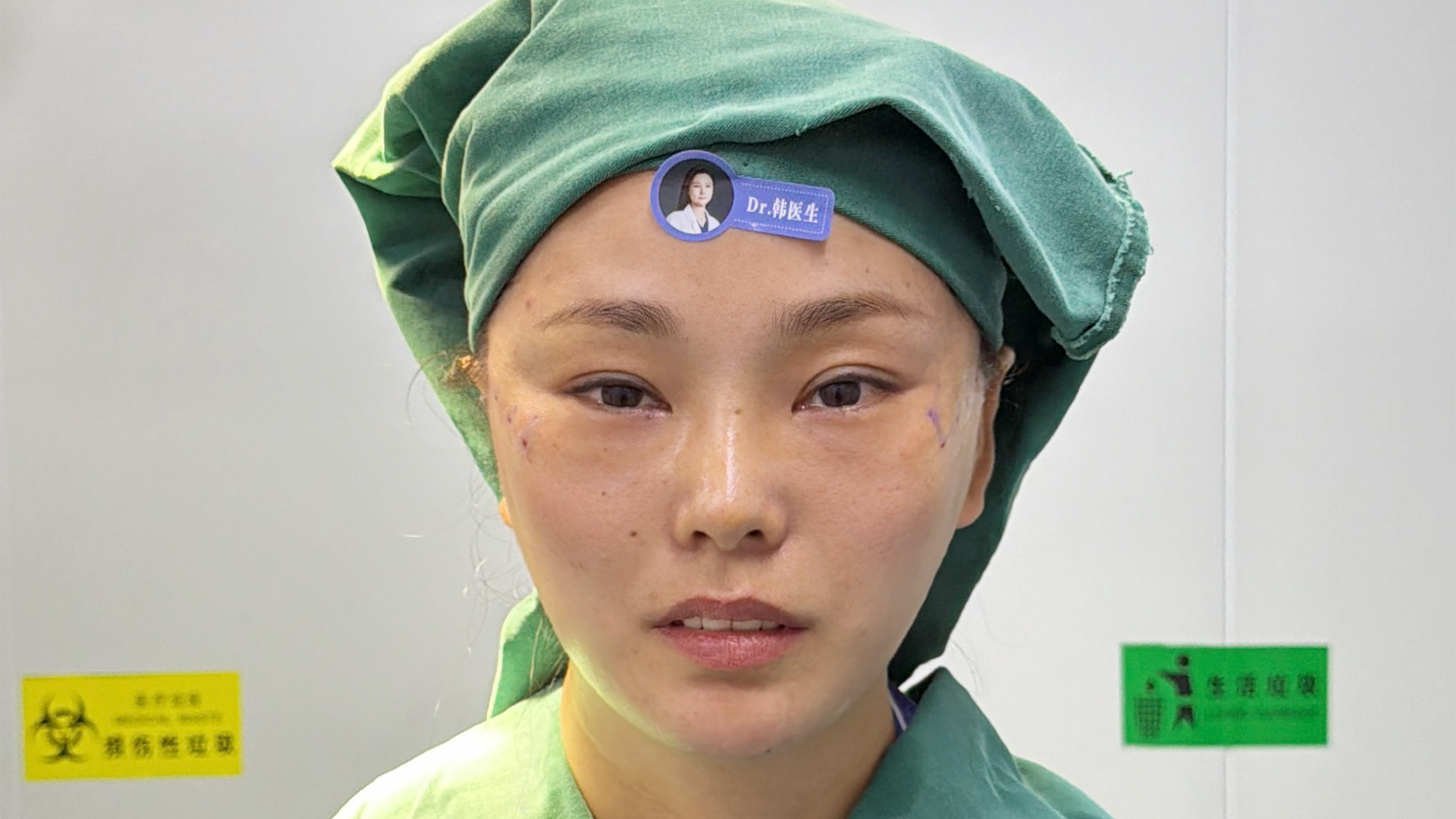 Thread Lift - Post-Procedure
