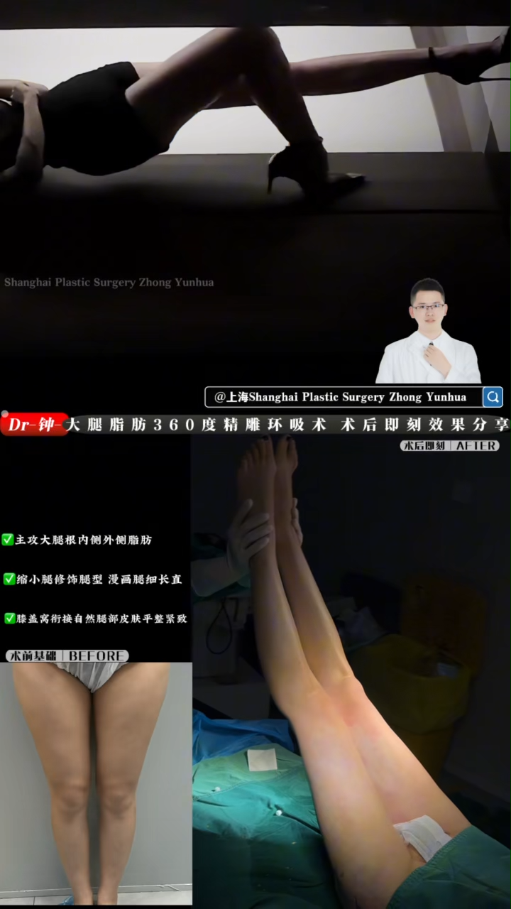 Liposuction with 360-degree sculpting for thigh fat 360