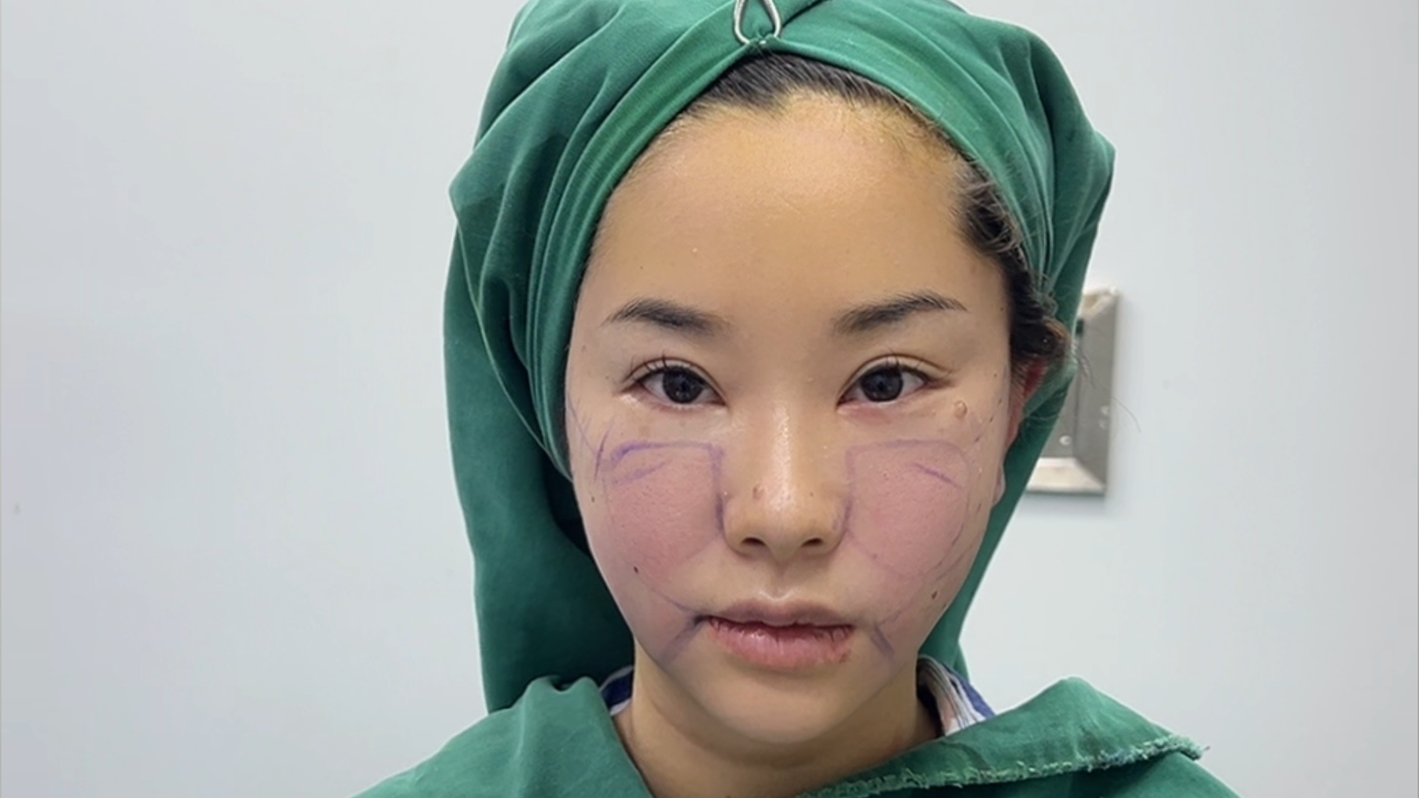 Perioral pouch improvement - Post-op