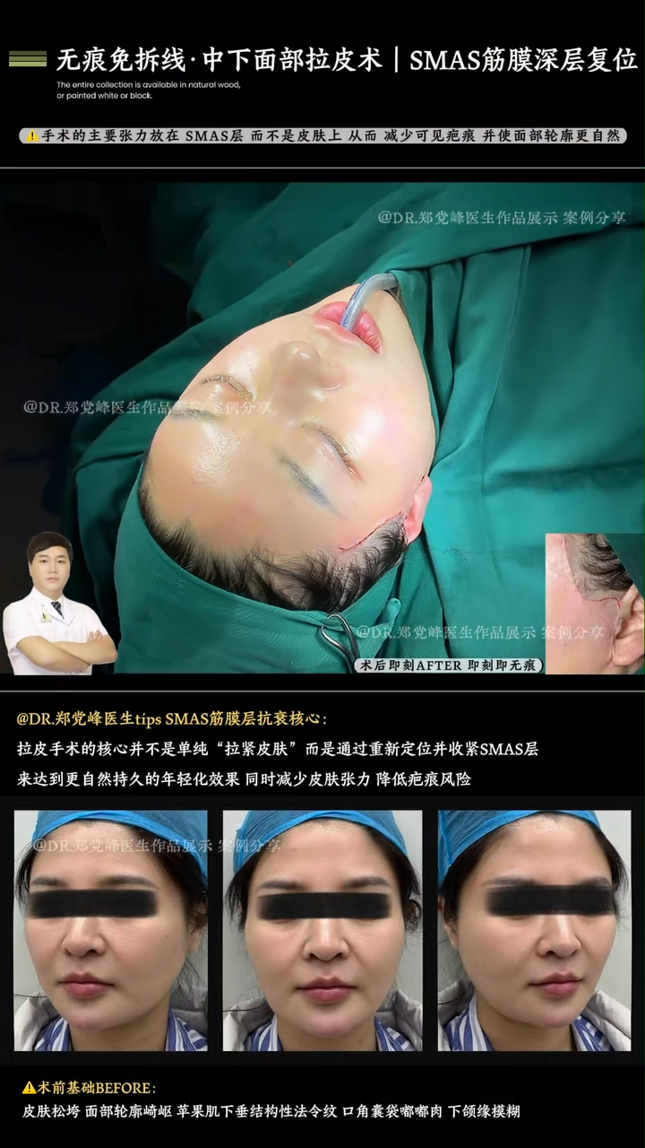 Invisible, Suture-Free Mid-to-Lower Face Lift | Deep SMAS Fascia Repositioning