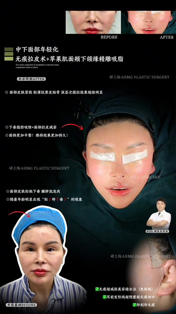 Youthful Lower and Mid-Face
Scarless Facelift + Contoured Liposuction for Apple Cheeks, Cheeks, and Jawline