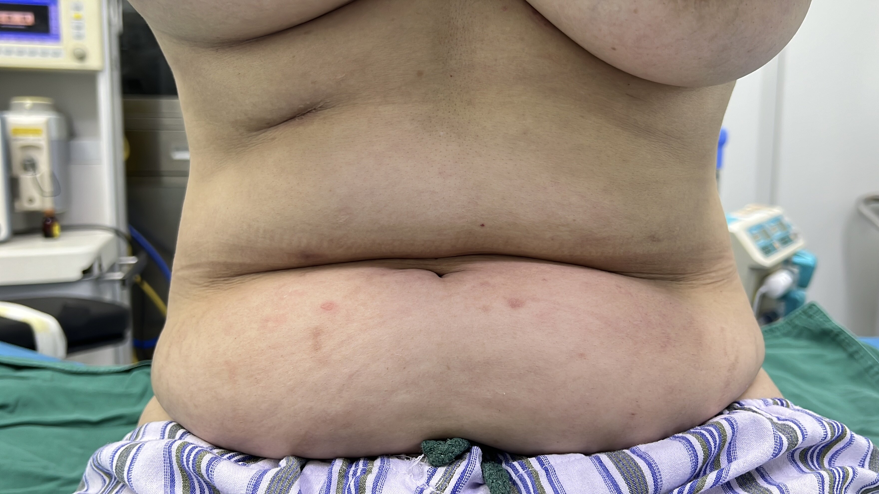 Full-Body Liposuction and Contouring – Pre-Procedure