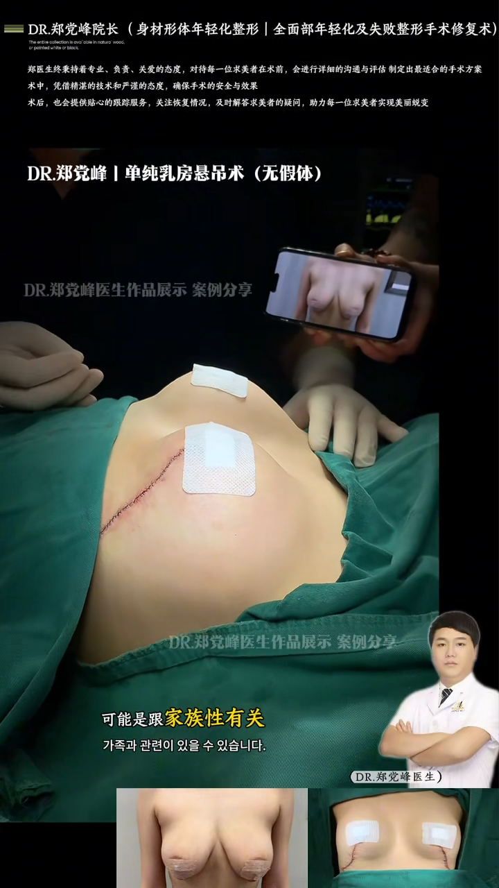 Mastopexy (without implants)