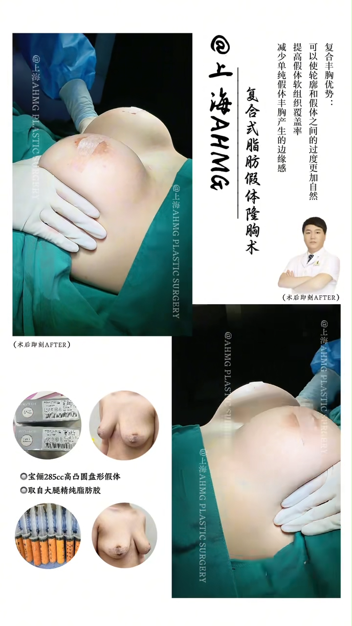 Breast Enhancement