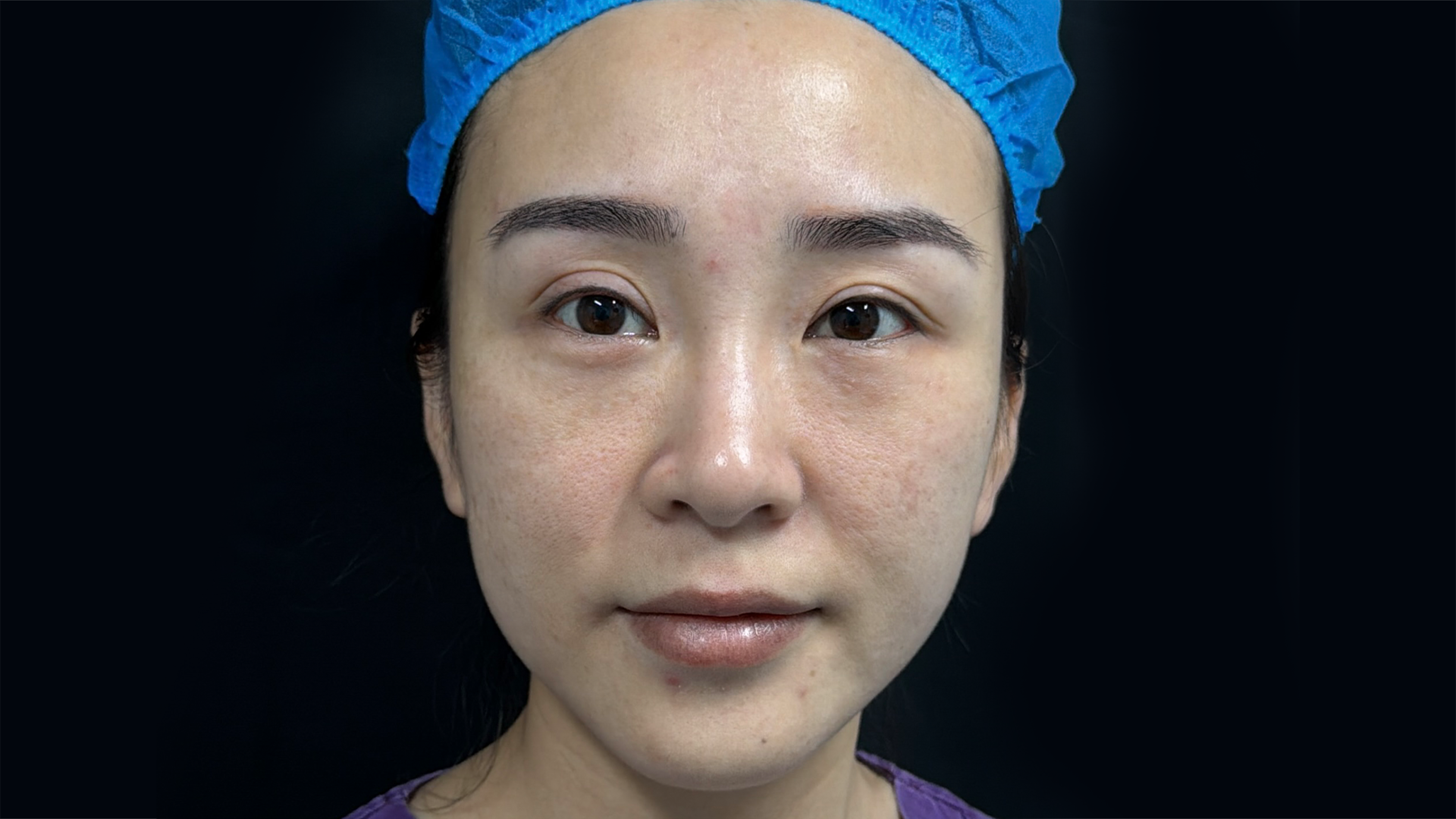 Pre-treatment: Nasolabial Fold Reduction