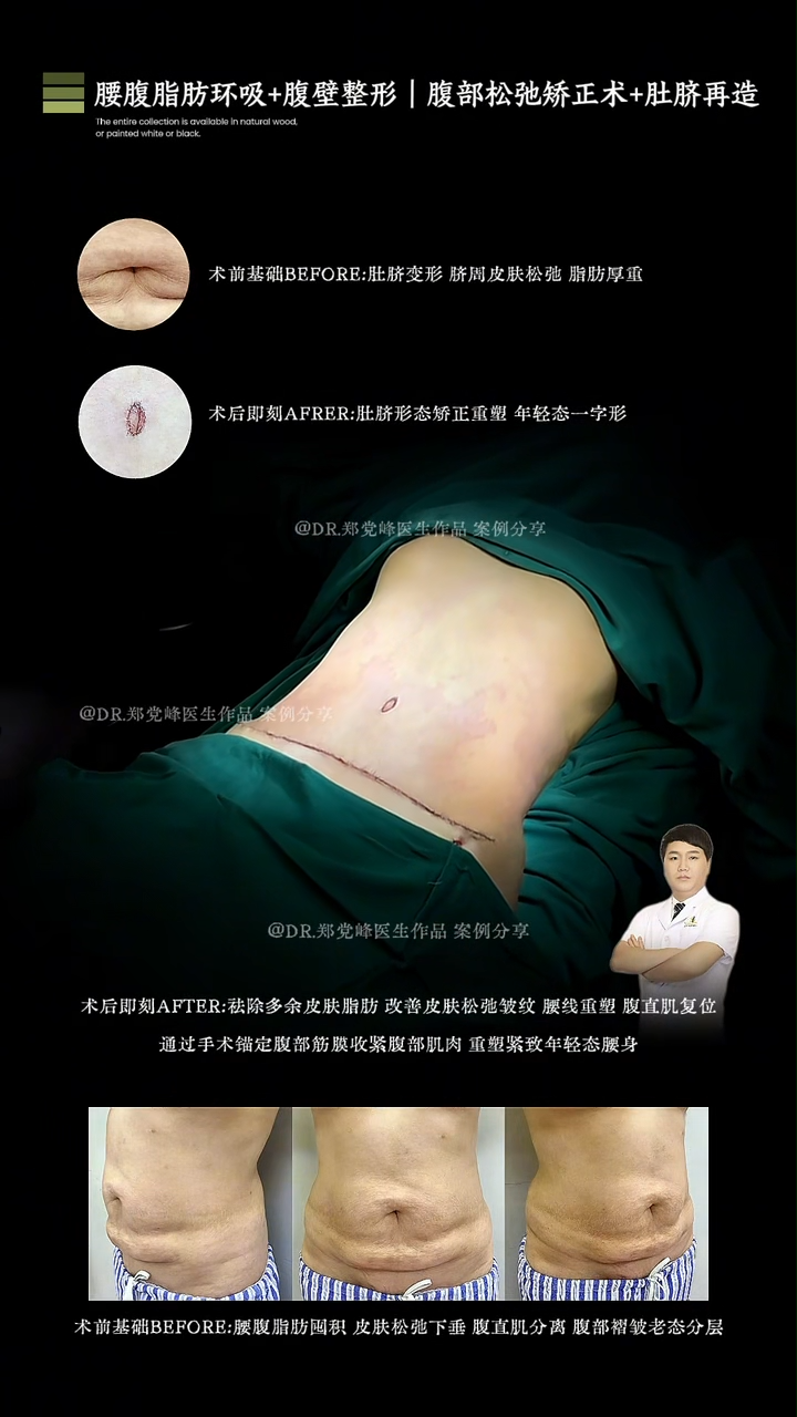 Liposuction of the waist and abdomen, combined with abdominoplasty for abdominal laxity correction and umbilicoplasty.