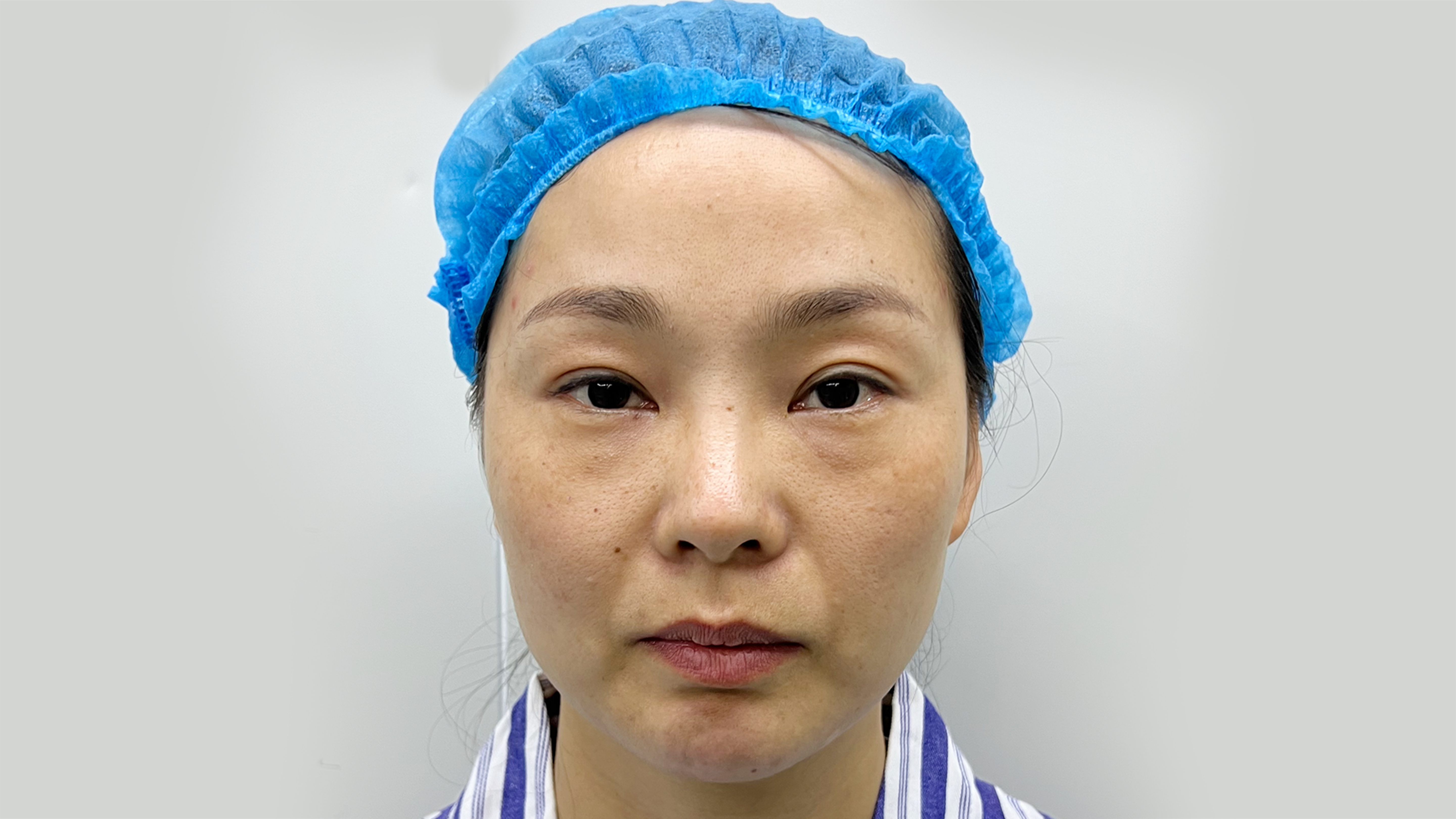 Thread Lift - Pre-Procedure