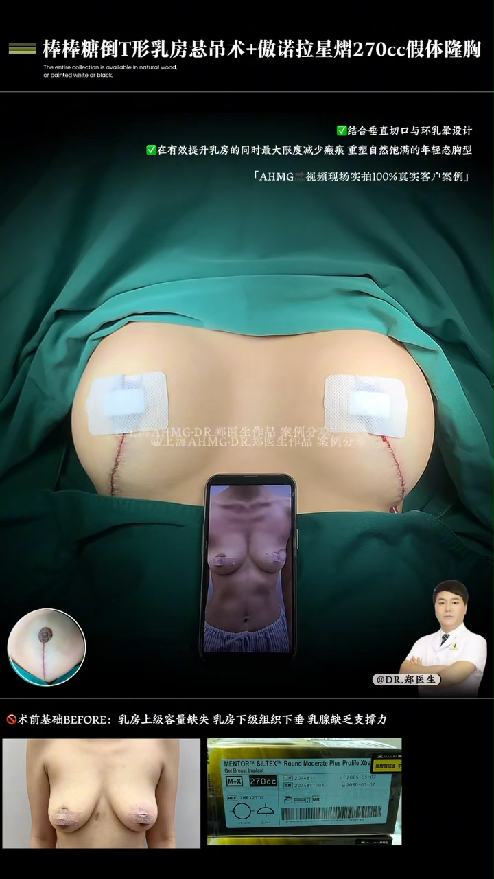 Lollipop inverted-T breast lift + Allurion Starlight 27cc implant augmentation