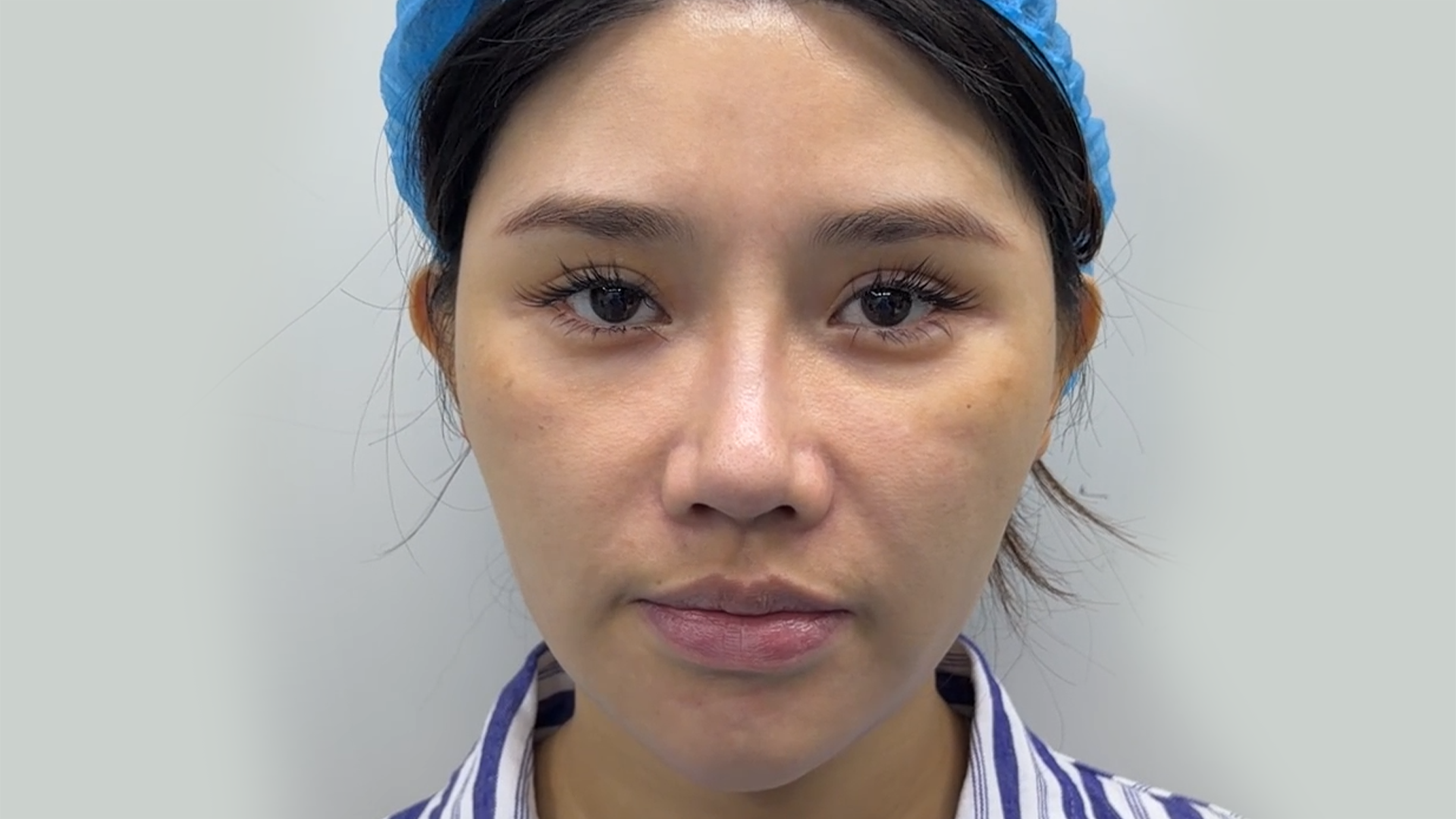 Cheek Lift - Pre-op