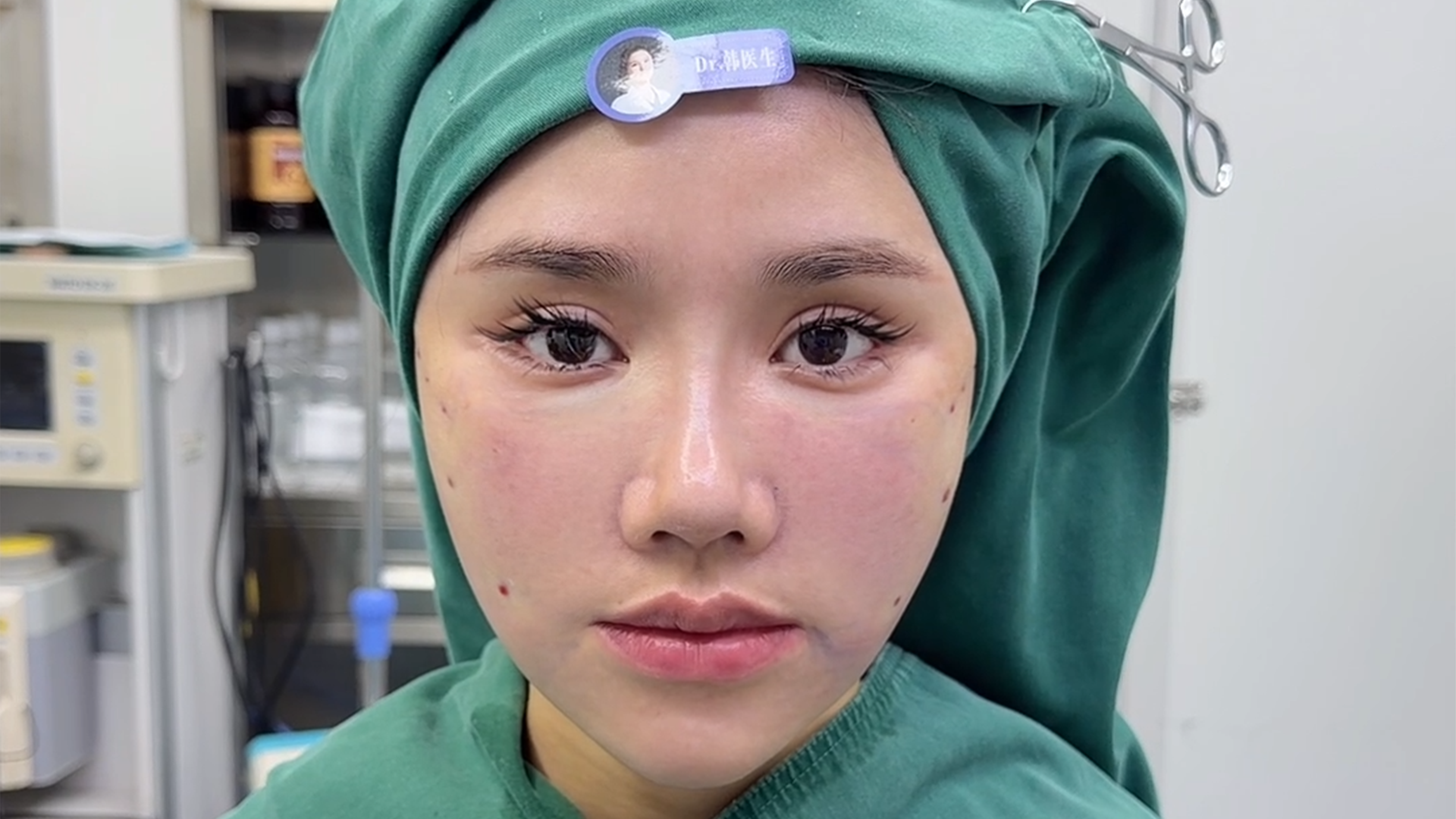 Apple Cheek Lift - Post-Op