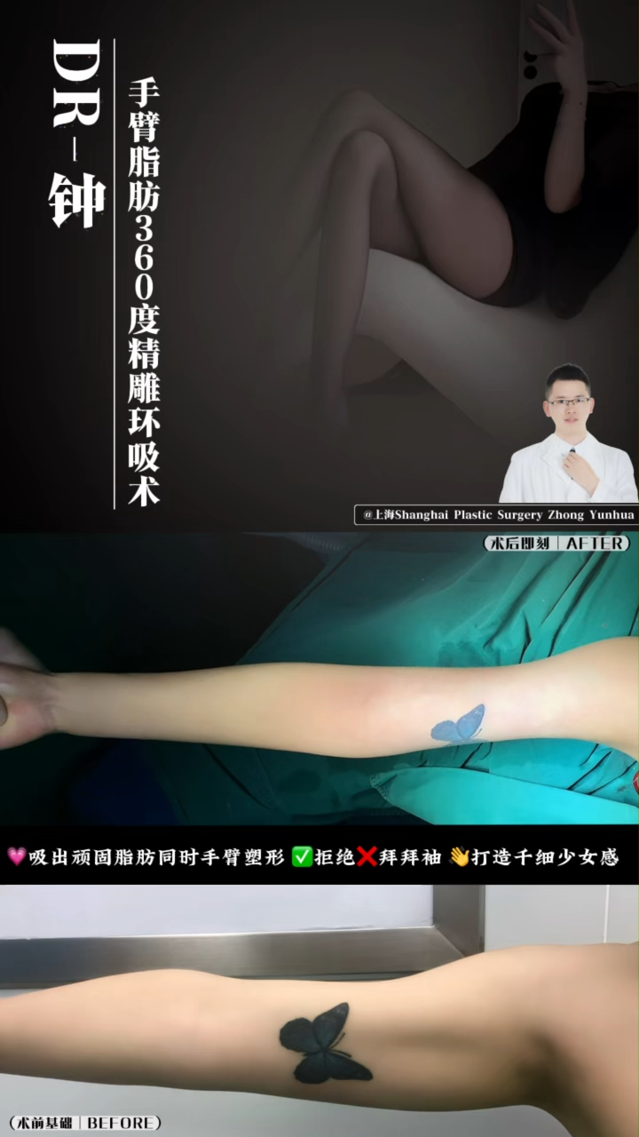 Arm Fat 360-Degree Sculpted Liposuction