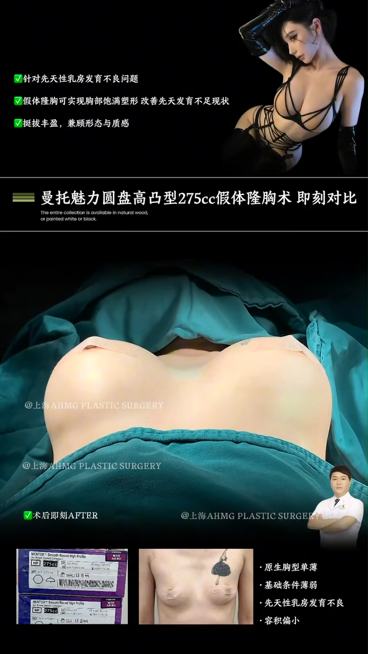 Mammoth MammoCharm Round High Profile 275cc Breast Augmentation