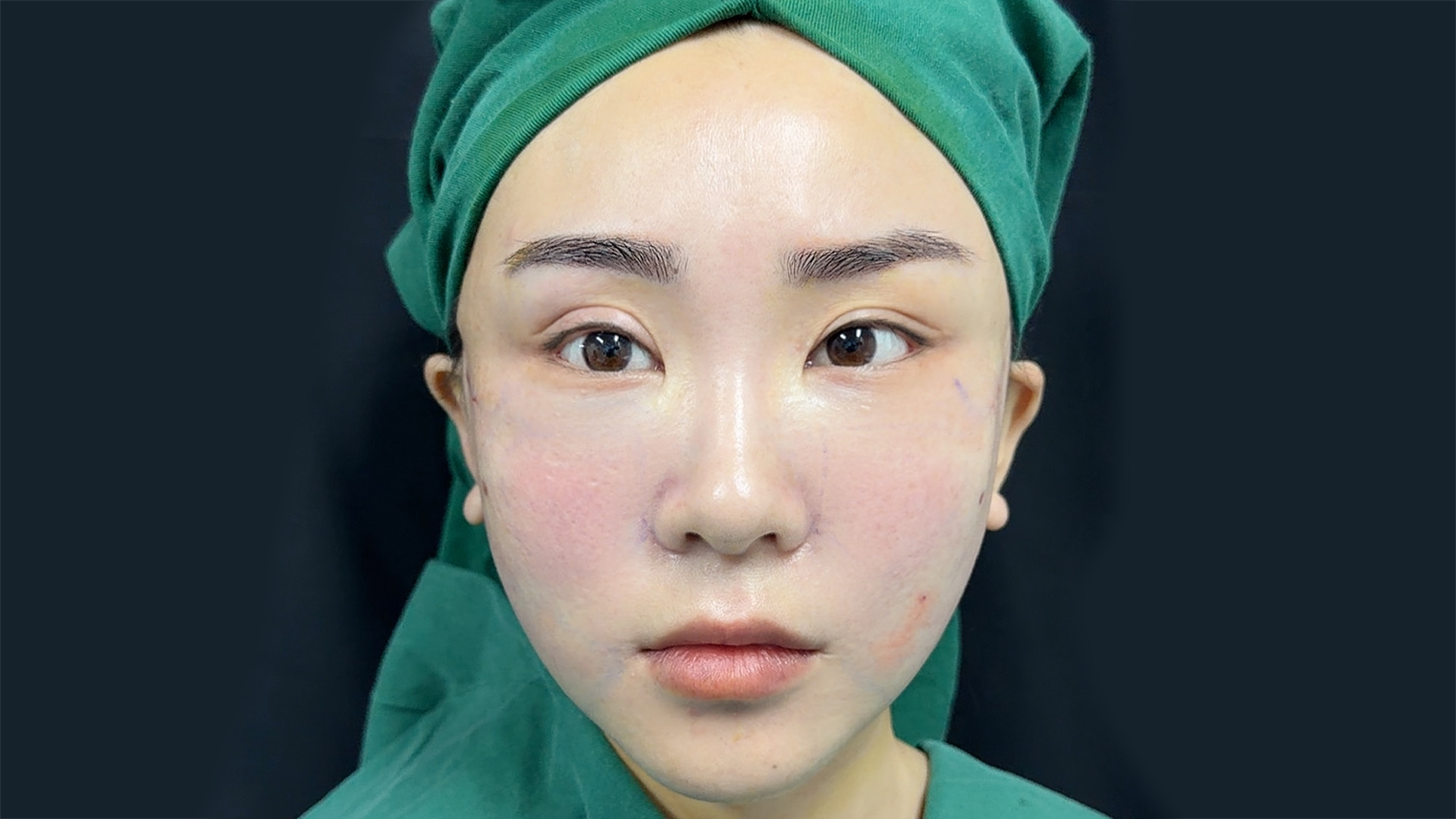 Post-procedure nasolabial fold reduction