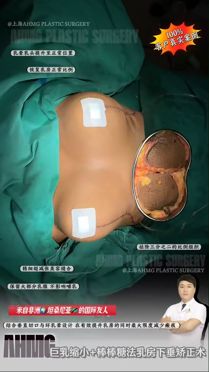 Breast reduction with lollipop technique for breast lift