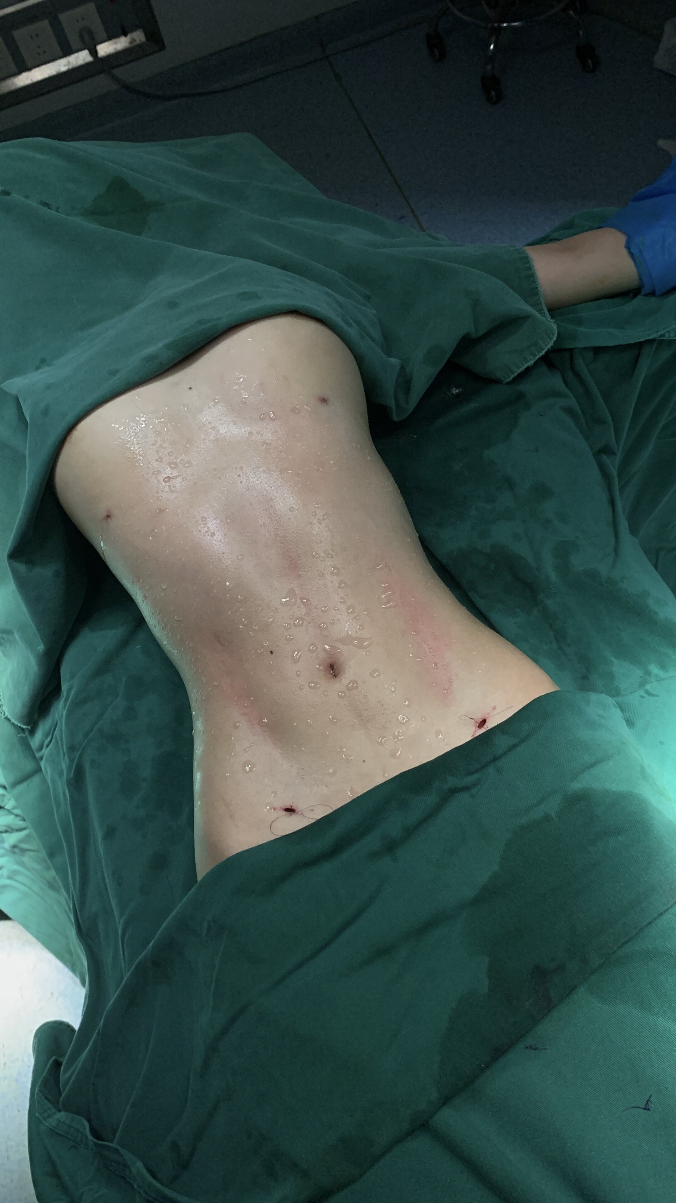 Body Liposuction and Contouring - Post-Procedure