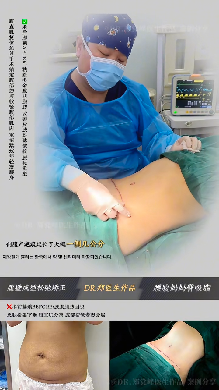 Abdominoplasty for Skin Laxity Correction and Liposuction for Waist, Abdomen, and "Mom Pouch"