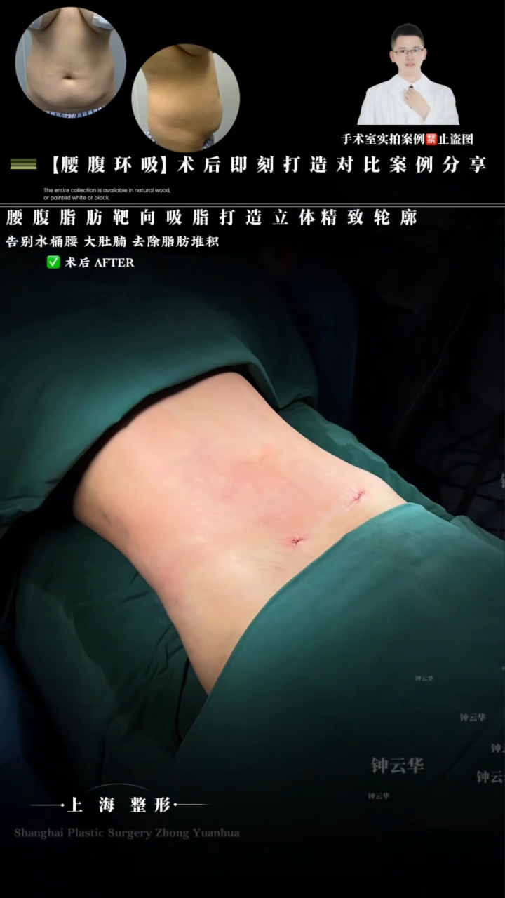 Say Goodbye to Saddlebags and Belly Fat: Fat Removal Procedure