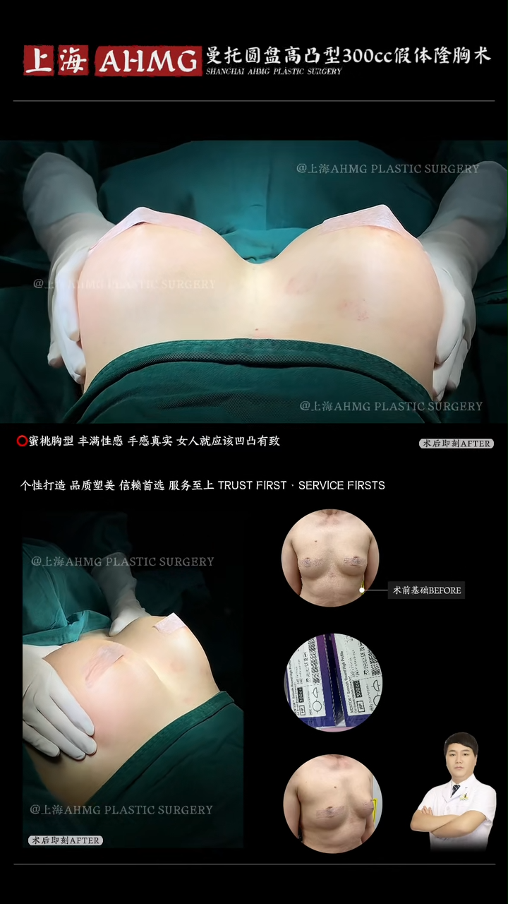 Mammoth Round High Profile 300cc Breast Implant