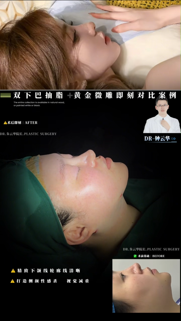 Double Chin Liposuction with Gold Sculpting