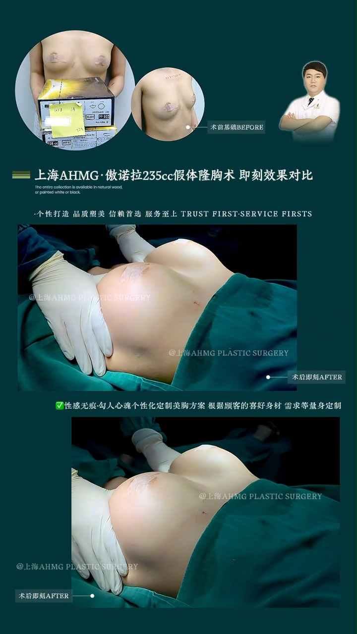 Allergan 23 5cc breast implant augmentation