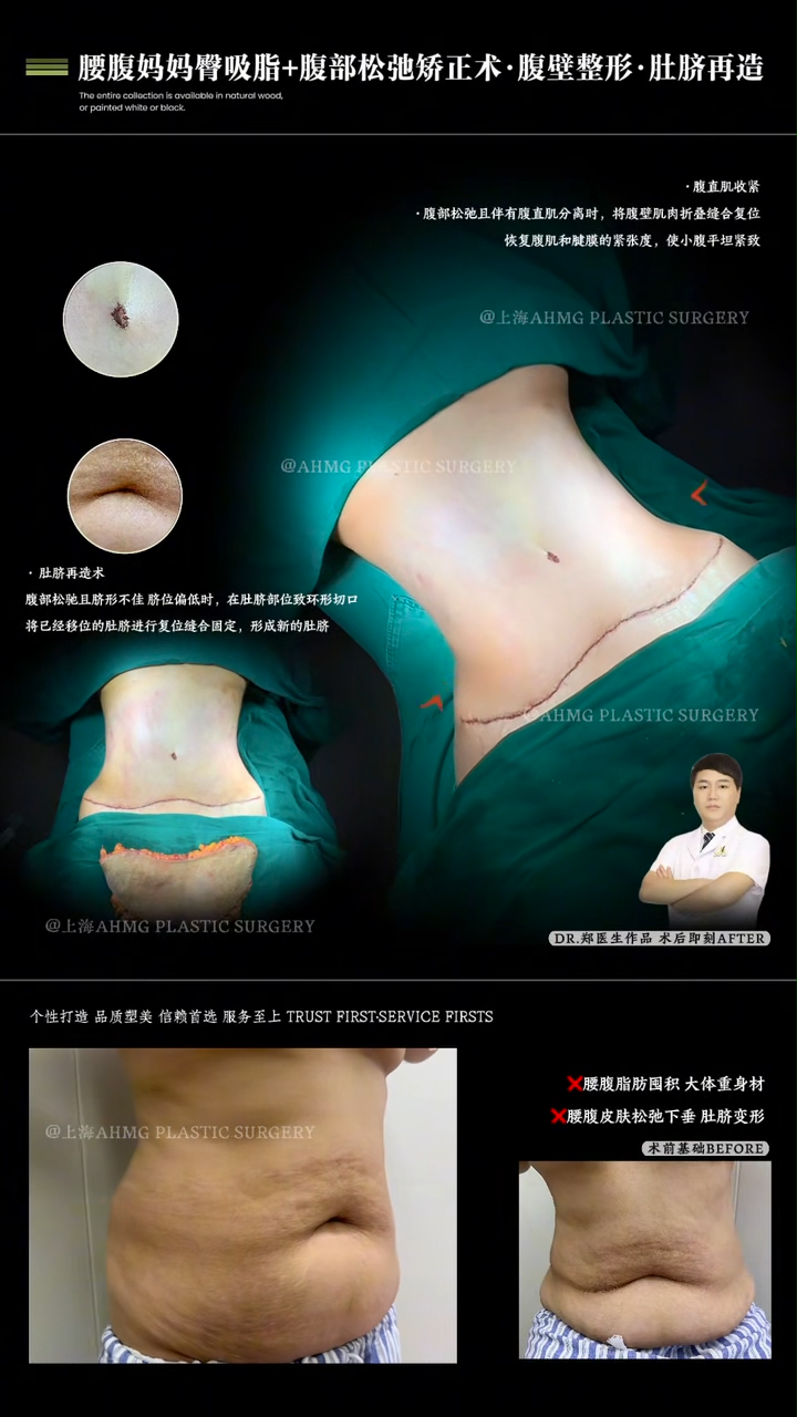 Liposuction for Waist, Abdomen, and Mummy Tuck + Abdominal Skin Redundancy Correction · Abdominoplasty · Umbilicoplasty