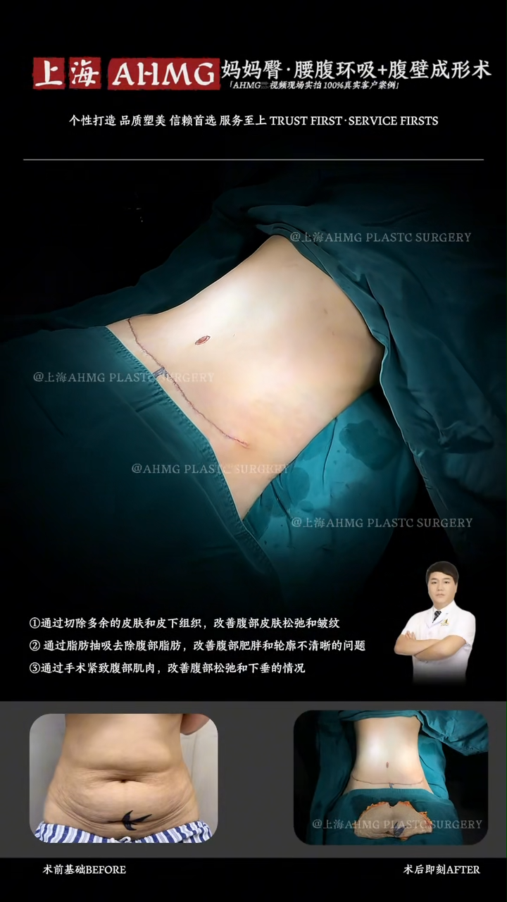Mommy Makeover: Liposuction of Hips and Abdomen + Abdominoplasty