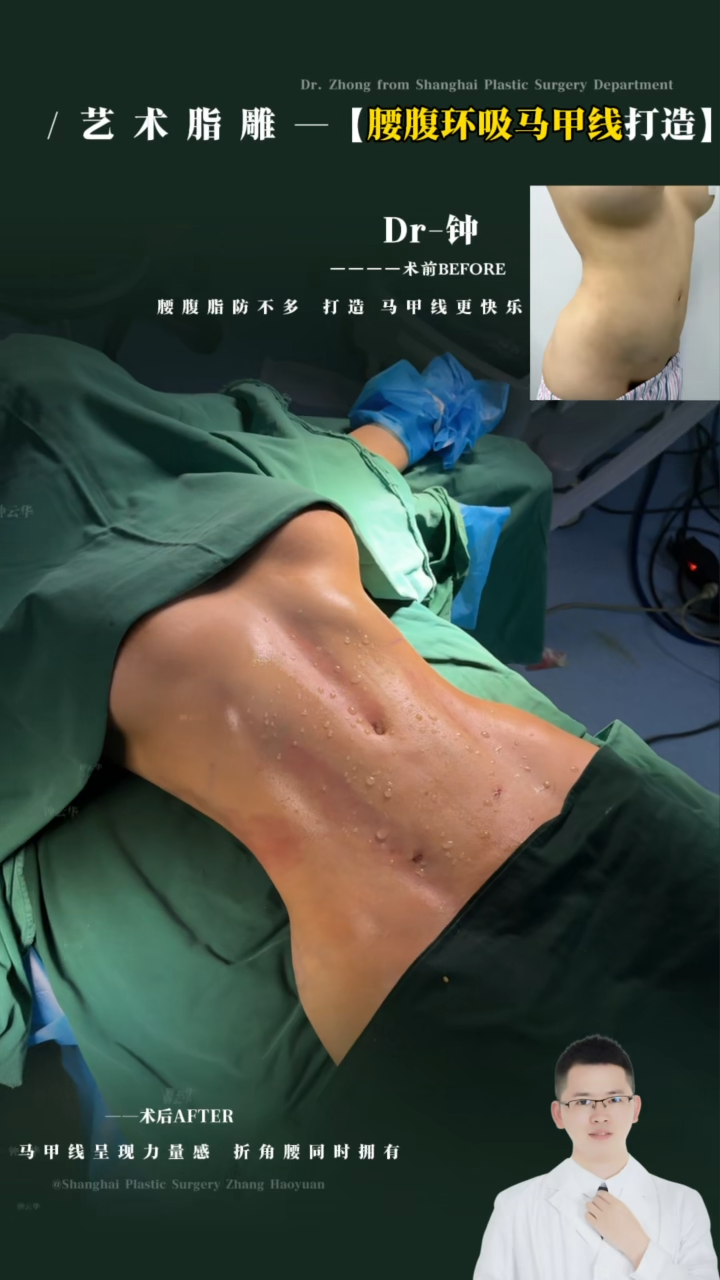Artistic Liposculpture I: Waist & Abdominal Contouring with V-Line Definition