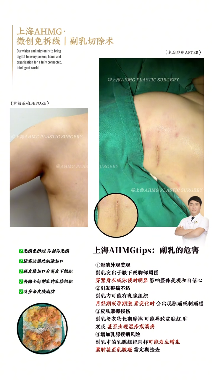 Minimally Invasive Sutureless | Accessory Breast Removal