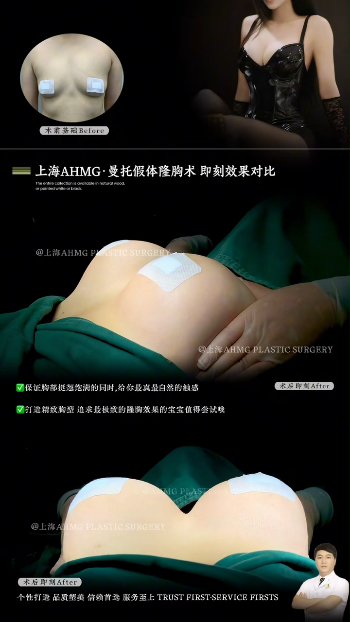 Allergan 23 5cc breast implant augmentation