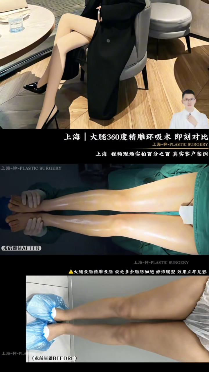 Thigh contouring liposuction at 360 degrees
