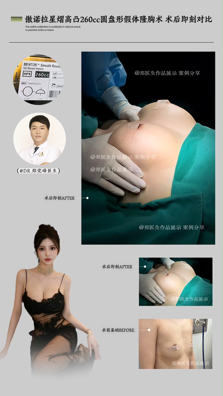 Aurora Star Glow High Projection 260cc Disc-shaped Breast Implant