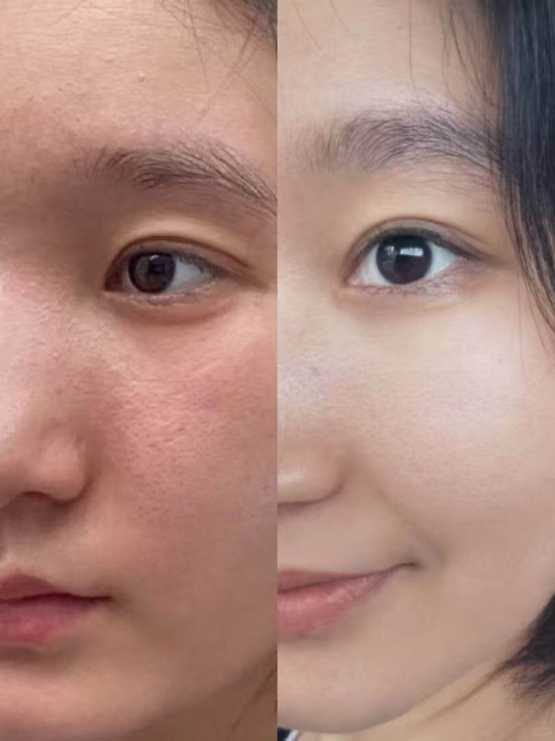 面部提升案例