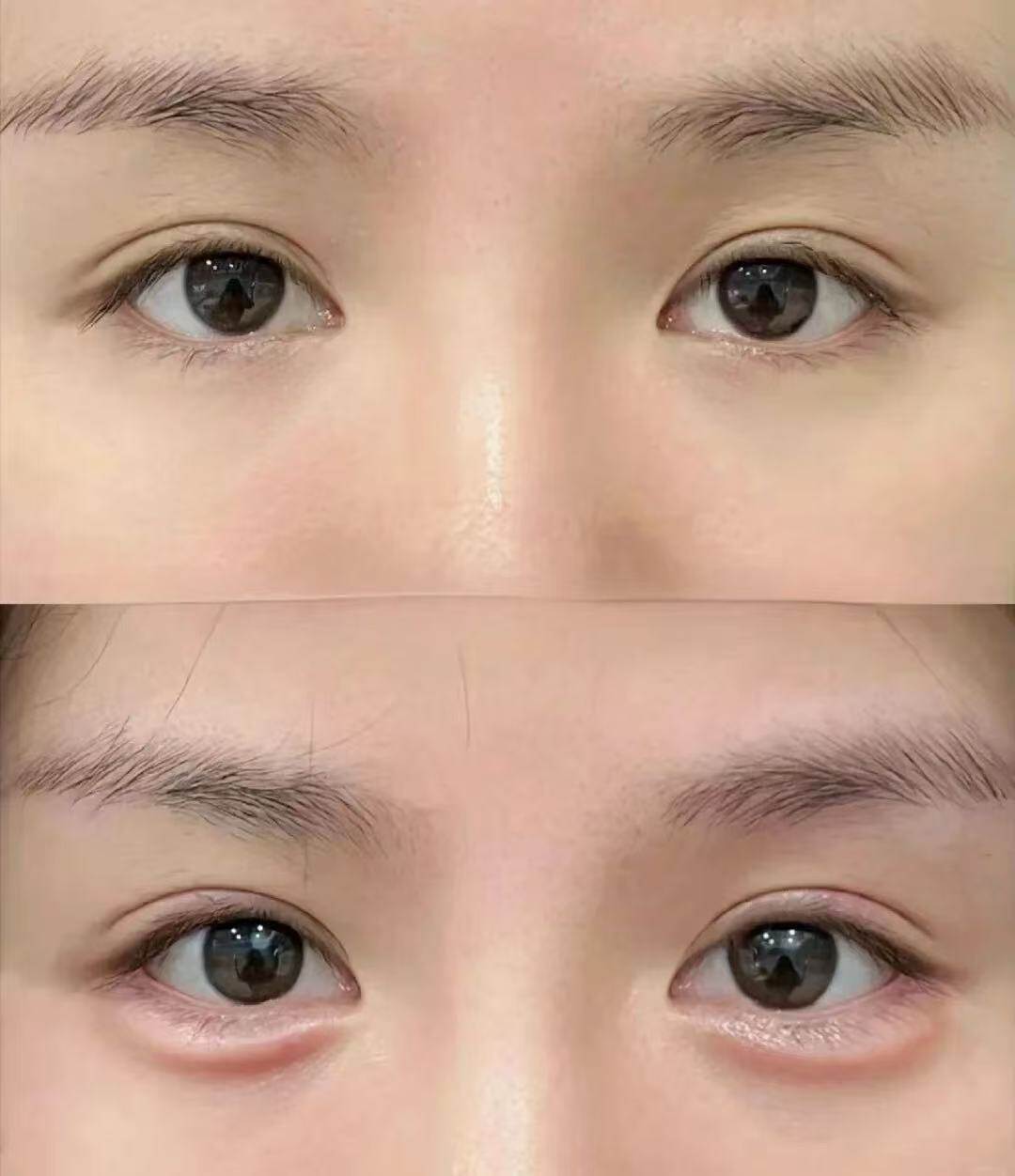 双眼皮案例